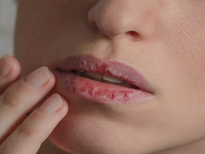 خشکی لب