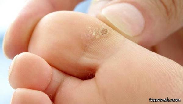 درمان های خانگی برای زگیل زگیل