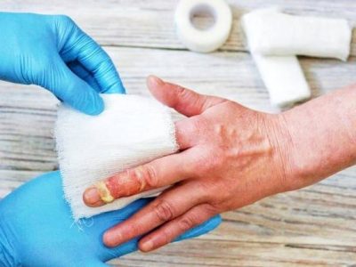 سوختگی شدید