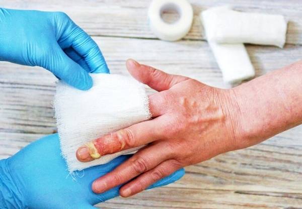 کمک های اولیه بعد سوختگی را بخوانید و بدانید سوختگی شدید