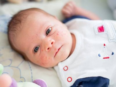 جوش-های-نوزاد