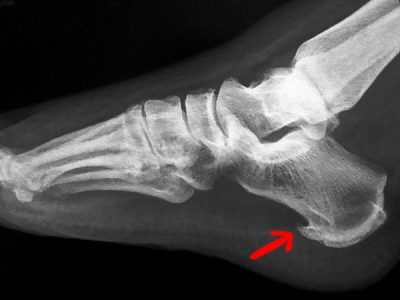 خار-استخوانی-پاشنه-پا