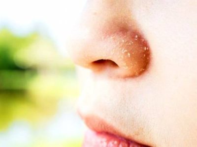 خشکی-پوست-بینی