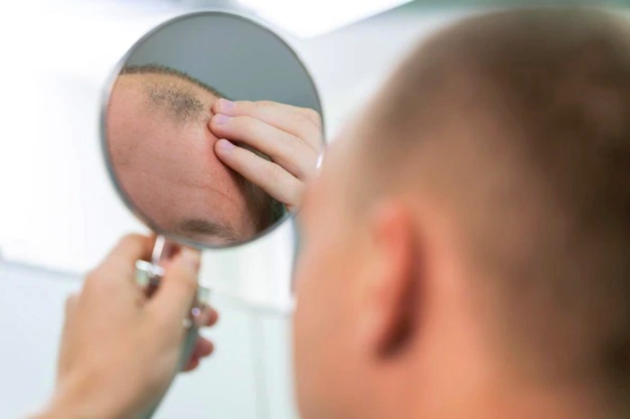 ارتباط روتین ورزش با ریزش مو ریزش-مو