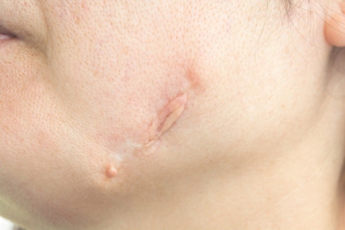 راهکارهای گیاهی برای رفع اسکار کلوئید و گوشت اضافه جای زخم کلوئید-چیست