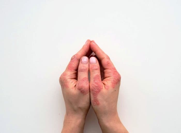 بررسی ارتباط اگزما و استرس اگزما-و-اضطراب