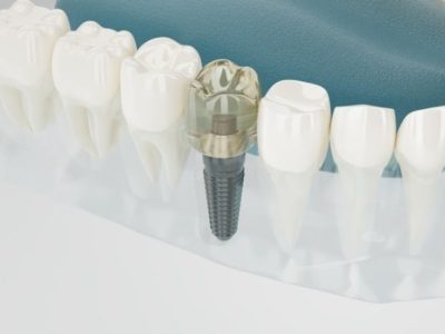 ایمپلنت-دندان