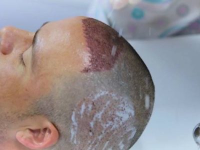 اصول شستشوی صحیح سر بعد از کاشت مو