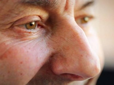 چند تغییر چشم ها که جزو علائم پارکینسون هستند