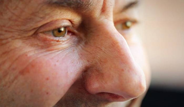 چند تغییر چشم ها که جزو علائم پارکینسون هستند