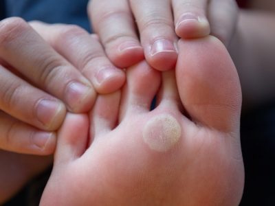 درمان سریع میخچه