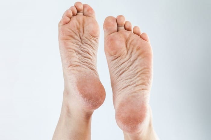 روش های فوق العاده ساده و خانگی برای درمان ترک کف پا ترک کف پا