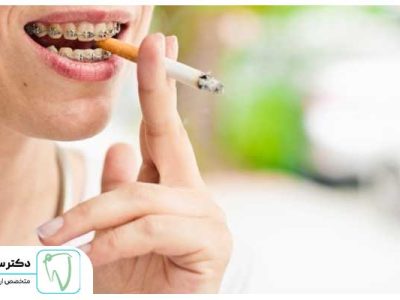 آیا سیگار برای ارتودنسی ضرر دارد