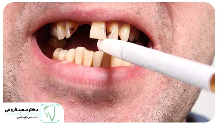 سیگار برای ارتودنسی