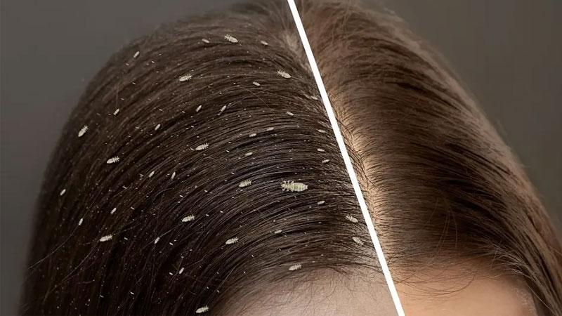 تشخیص و درمان شپش با موهای اکستنشن